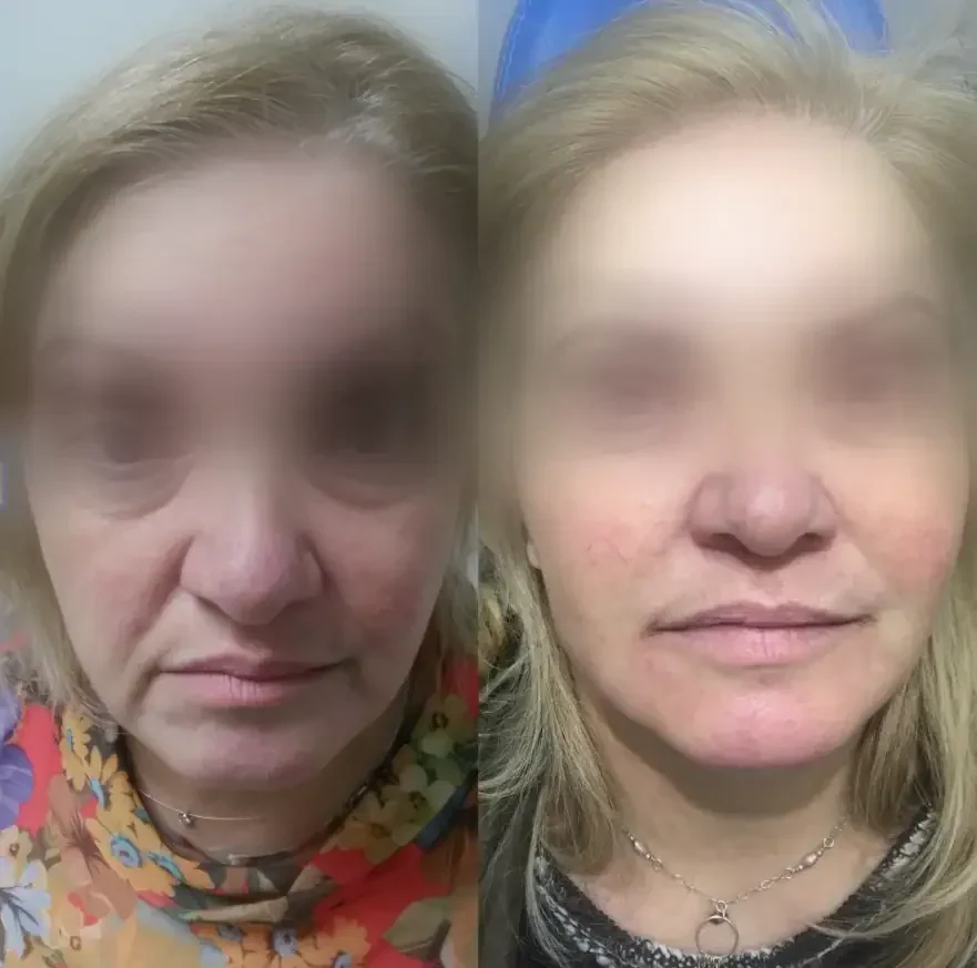 Profhilo bio-remodelling — non-cross-linked HA spreads through tissue to stimulate collagen